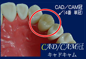 CAD/CAM冠