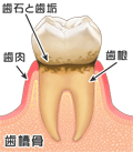 歯と歯ぐきの間に歯石や歯垢が溜まっている状態